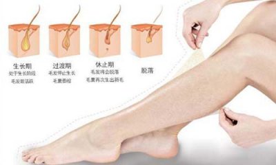 夏季脫毛：為什么有人說光子脫毛沒有效果？