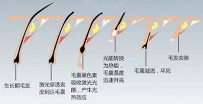 為什么有時候感覺家用脫毛儀效果不明顯？(圖2)