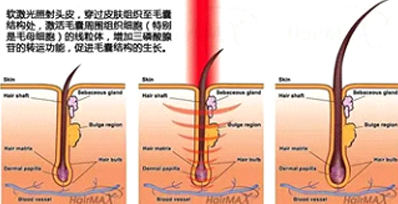 永久脫毛有哪些方式和對比效果