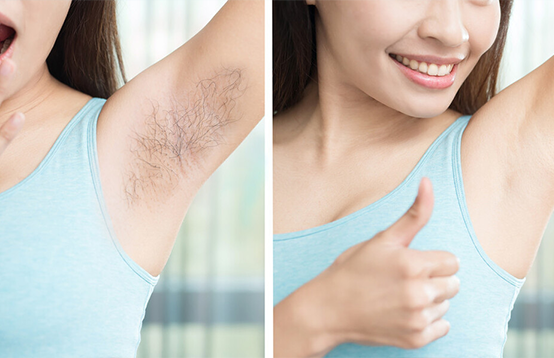 哪些人不適合做光子脫毛(圖2)